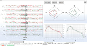 Emboli detection-NMA: Man 57 years, carotis stenosis post-operative.