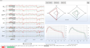 Emboli detection-NMA: Man 57 years, carotis stenosis pre-operative.