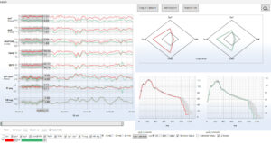 Monitoring-NMA: Woman 50 years, migraine.